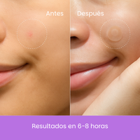 NuaSkin® Parches Auxiliares de Hidrocoloide para el Acné - 3 Pack (108 Parches Invisibles)